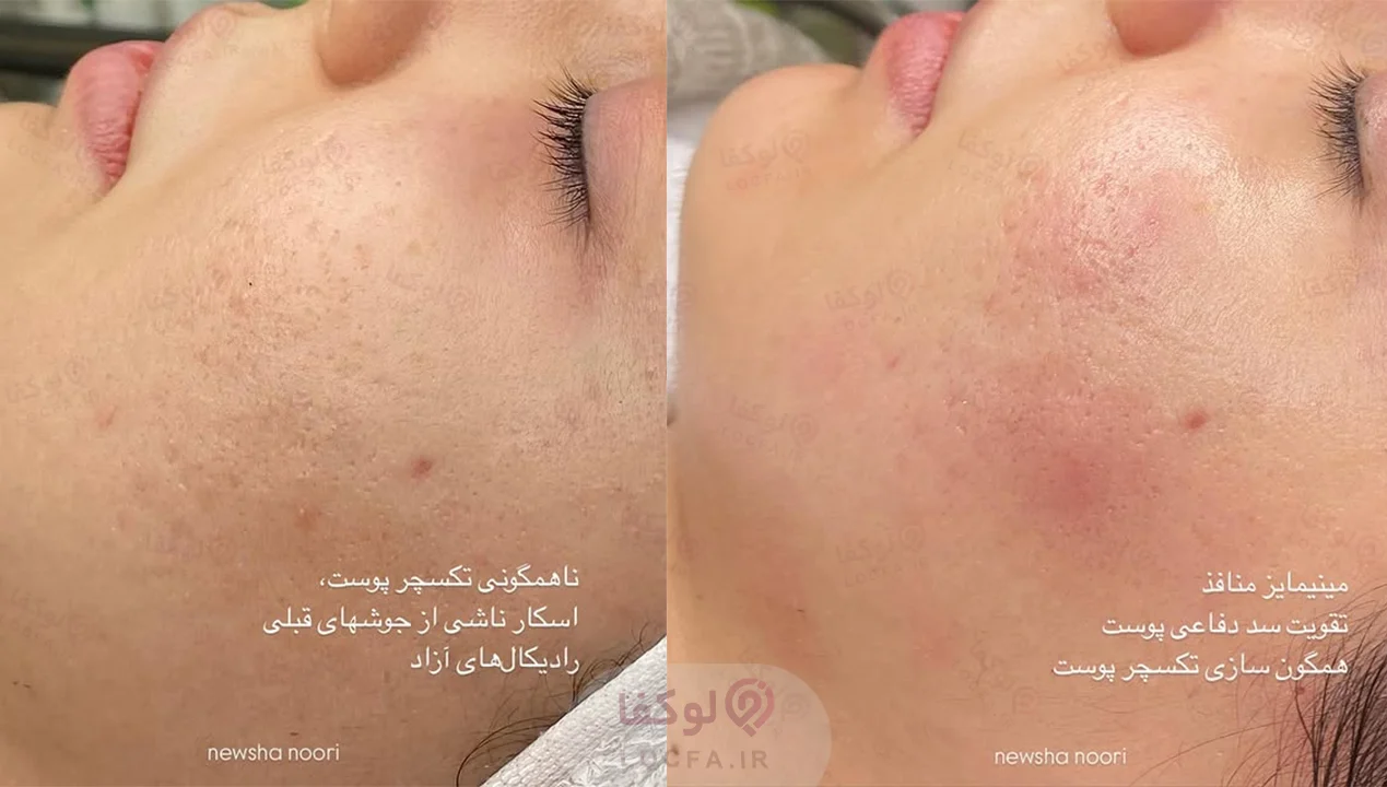بهترین مرکز فیشیال غرب تهران | 11 مرکز پاکسازی پوست 14 فیشیال در شهران - لوکفا