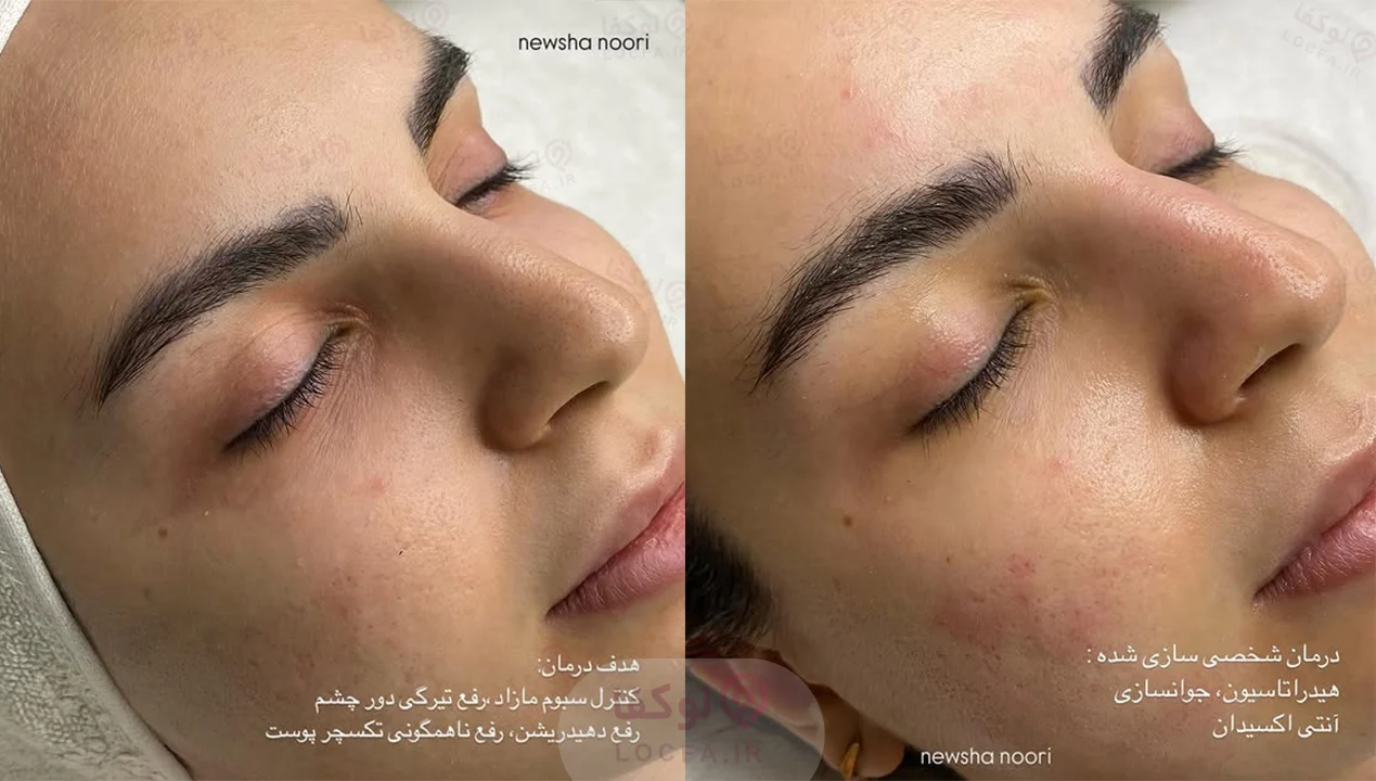 بهترین مرکز فیشیال غرب تهران | 11 مرکز پاکسازی پوست 12 آیلا کلینیک | کلینیک زیبایی غرب تهران - کلینیک پوست و مو غرب تهران - لوکفا