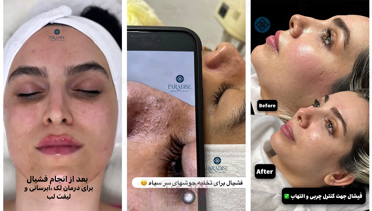 بهترین مرکز فیشیال غرب تهران | 11 مرکز پاکسازی پوست 25 سالن فیشیال در شهرک غرب - لوکفا